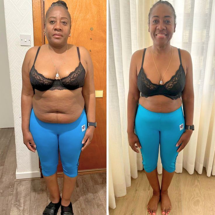 Antes e depois anti-inchaço feminino